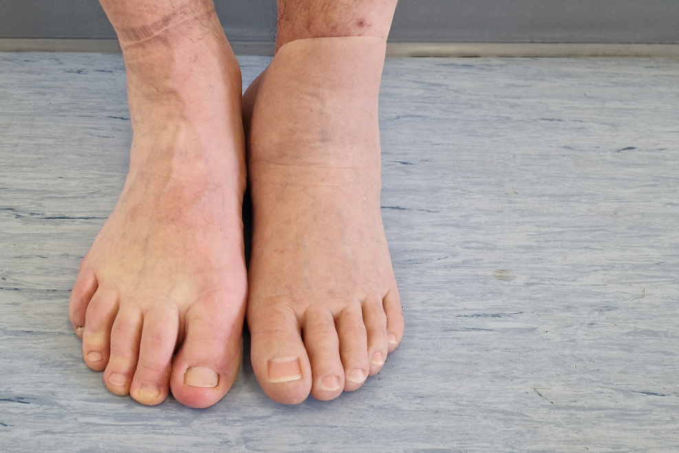 Zwei Füße nebeneinander, der rechte wurde aus Silikon nachgebaut